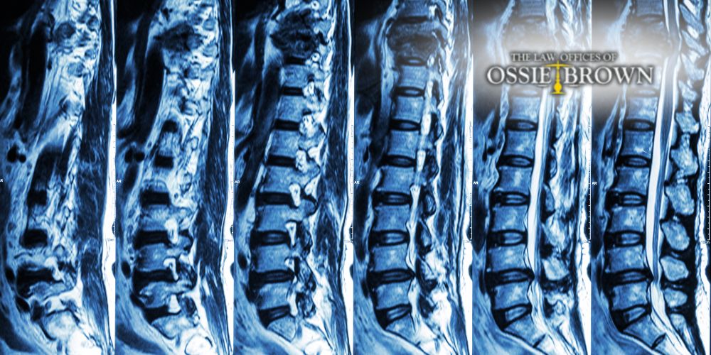 DUI Accident Lawyer Baton Rouge